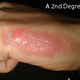 Image for article titled Scientists created a pain measurement scale by burning the hands of women in labor